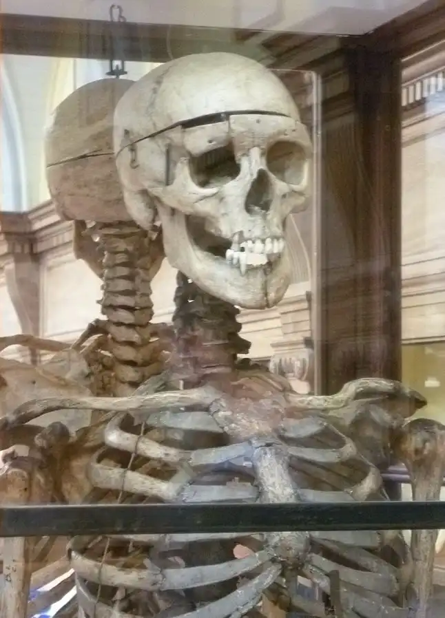 William Burke's Skeleton at The Anatomical Museum Edinburgh via wikicommons